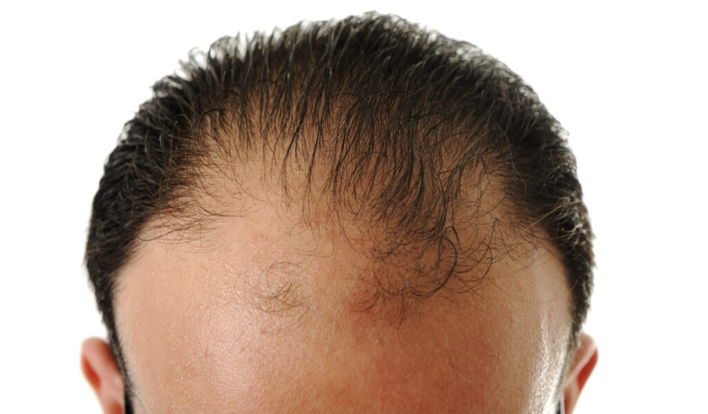 mens hairline solutions Shelton CT